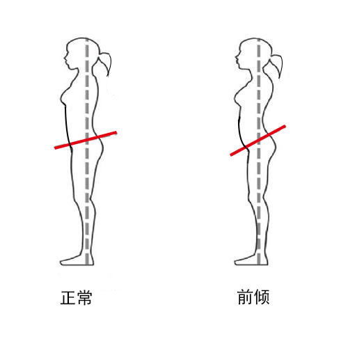 骨盆前倾示意图.jpg